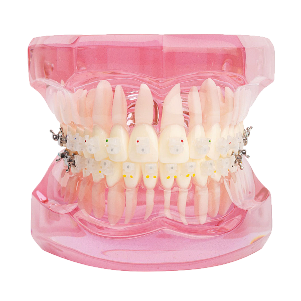 Брекет GEM SERIES CERAMIC .022 MEDIUM TORQUE премоляр с кр. ВЧ/лев, на 24. 25 зуб