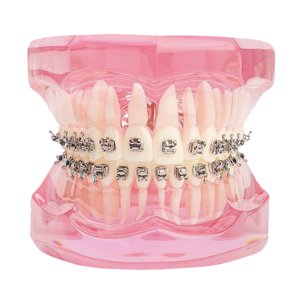 Брекет SELF-LIGATING SERIES .022 MBT 2-й премоляр с кр. НЧ/лев, на 35 зуб